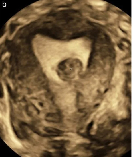 Uterusmyom (Uterus myomatosus) – Sonographie: 3D-Koronarschnitt: intrakavitäres Myom, das vollständig im Cavum liegt — FIGO 0