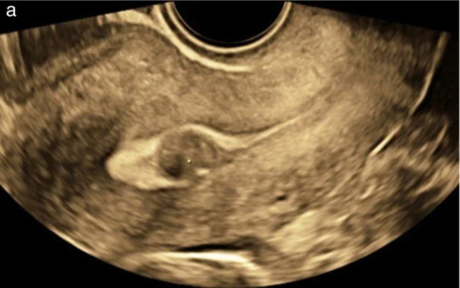 Uterusmyom (Uterus myomatosus) – Sonographie: Transvaginalsonographie sagittal: submuköses Myom mit Vorwölbung ins Cavum