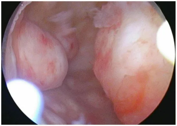 Uterusmyom (Uterus myomatosus) – Endoskopie & Makro: Hysteroskopie: mehrere submuköse Myomvorwölbungen im Cavum