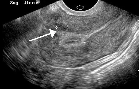 Uterusmyom (Uterus myomatosus) – Sonographie: Transvaginalsonographie sagittal: kleines intramurales Myom im Myometrium