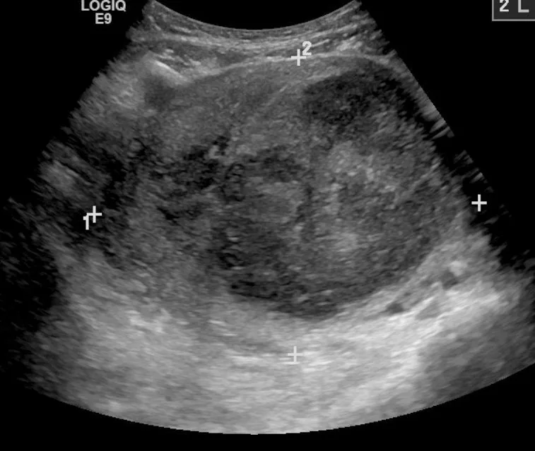 Uterusmyom (Uterus myomatosus) – Sonographie: Transabdominale Sonographie: 9 cm großes Myom — bei dieser Größe die übliche Schallführung