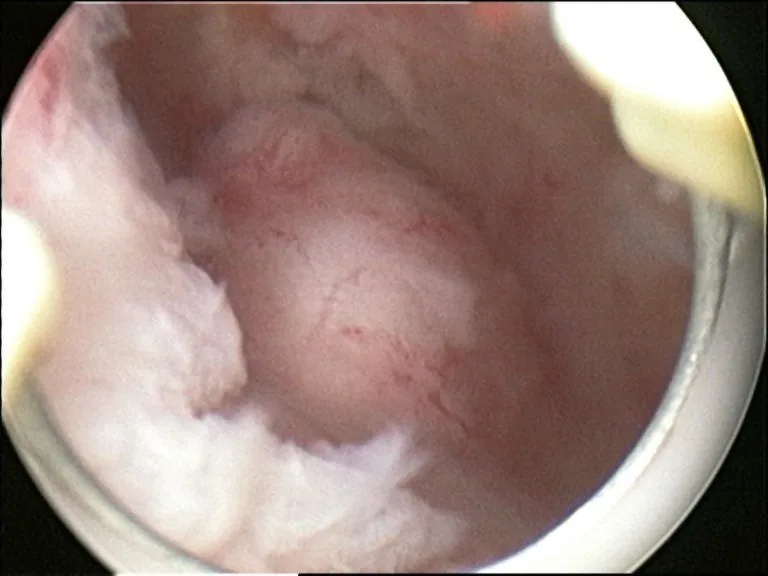 Uterusmyom (Uterus myomatosus) – Endoskopie & Makro: submuköses Myom der Uterushinterwand (Hysteroskopie)