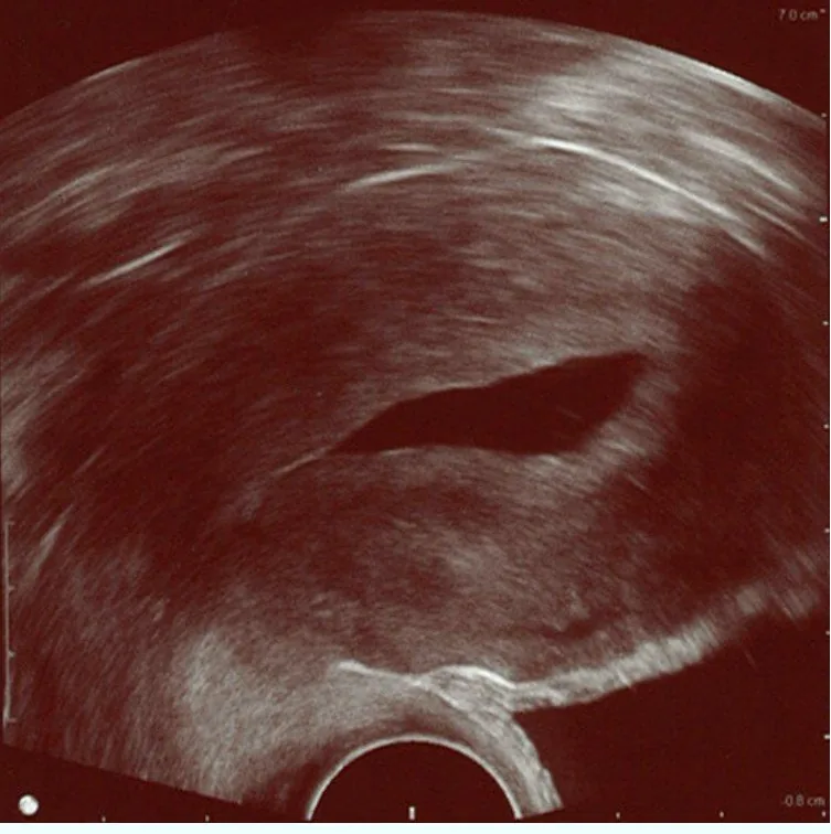 Uterusmyom (Uterus myomatosus) – Sonographie: Hydrosonographie (Saline Infusion Sonography): unauffälliges, vom Kochsalz entfaltetes Cavum