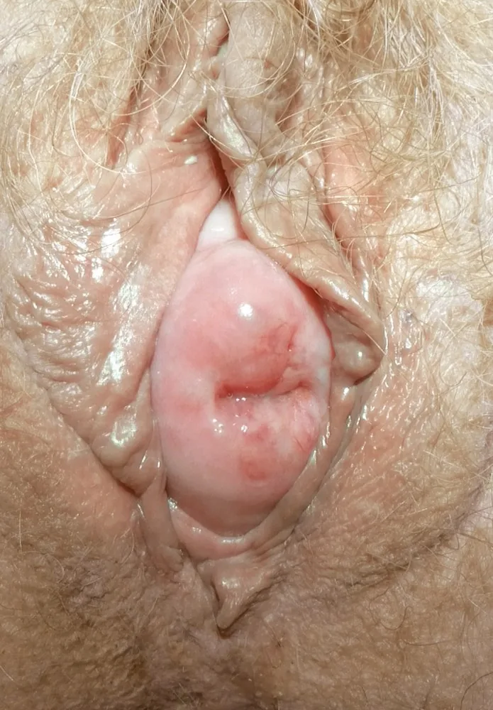 Uterine prolapse – Colposcopy