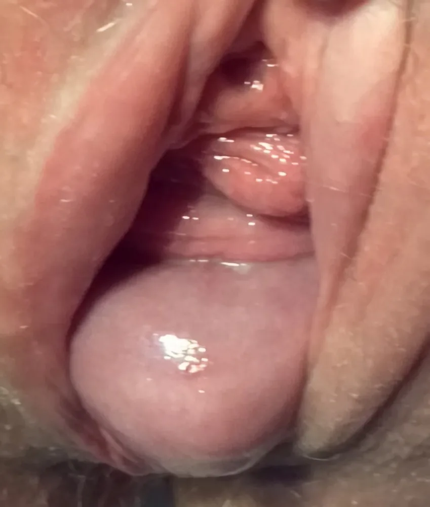 Uterusprolaps (Descensus uteri) – Klinik: Descensus uteri, im Stehen sichtbar