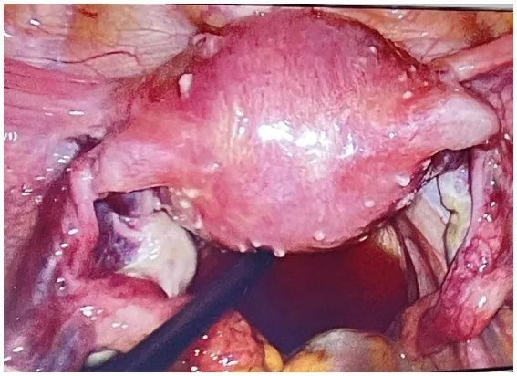 Uterine sarcoma (leiomyosarcoma) – Endoscopy & gross: Laparoscopy: uterus with numerous small fibroid nodules on the serosa — uterine myomatosis