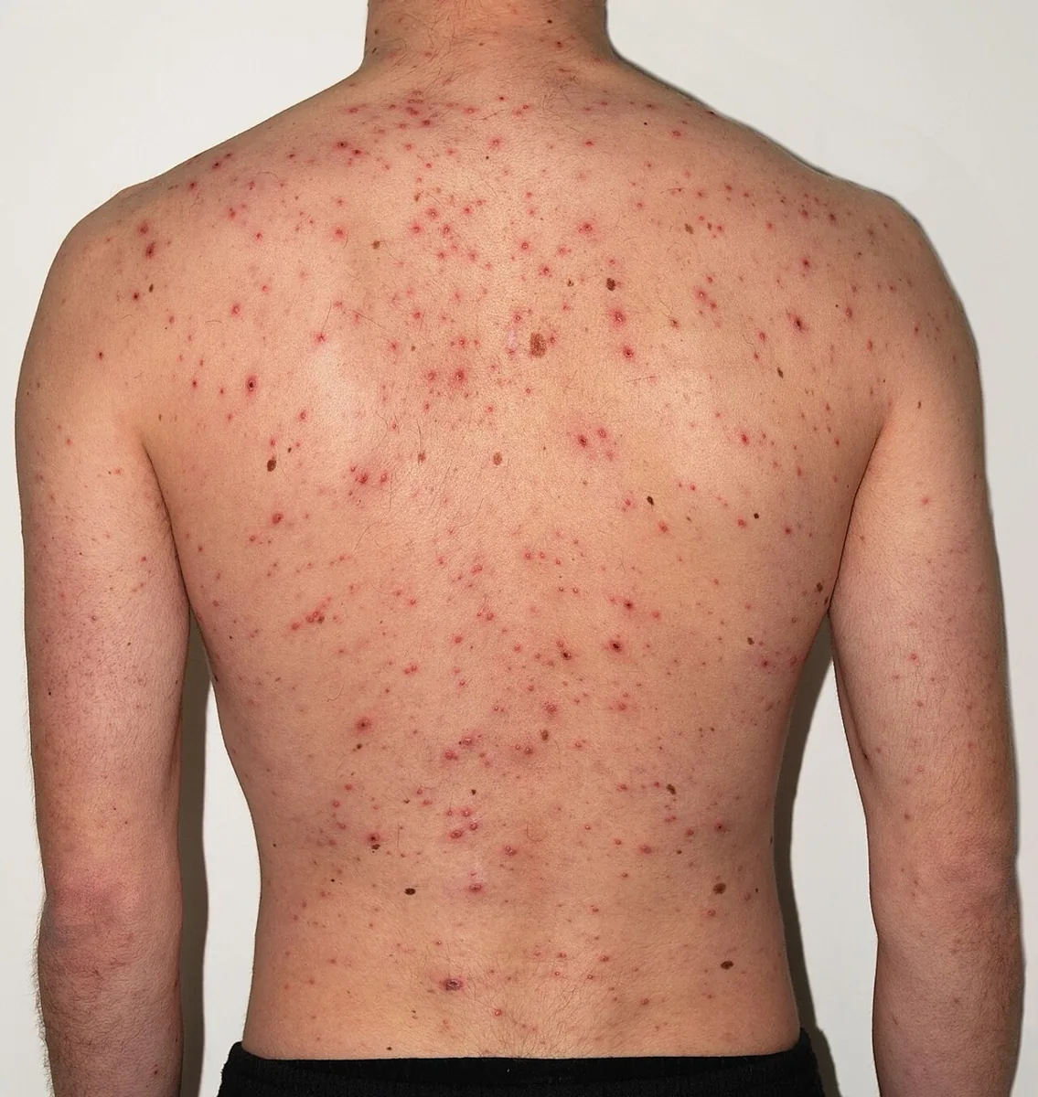 Varizellen in der Schwangerschaft – Klinik: Klinisches Foto: Varizellen beim Erwachsenen – generalisiertes Exanthem am Rücken mit Papeln, Bläschen und Krusten nebeneinander („Sternenhimmel“), Tag 5