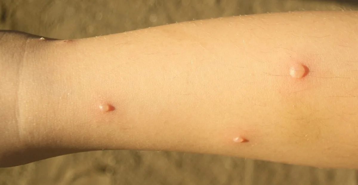 Varizellen in der Schwangerschaft – Klinik: Klinisches Foto: Varizellen – prall gefüllte, klare Bläschen („Tautropfen auf Rosenblatt“) am Unterschenkel
