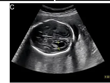 Ventriculomegaly and hydrocephalus – Ultrasound