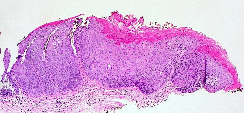 Vulväre intraepitheliale Neoplasie (VIN) – Histologie & Zytologie: Histologie (HE): Kernatypien über die ganze Epithelbreite mit Mitosen oberhalb der Basalschicht — VIN 3 / HSIL