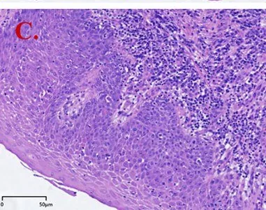 Vulväre intraepitheliale Neoplasie (VIN) – Histologie & Zytologie: Histologie: differenzierte VIN (dVIN) mit basaler Atypie und ausgereifter Verhornung