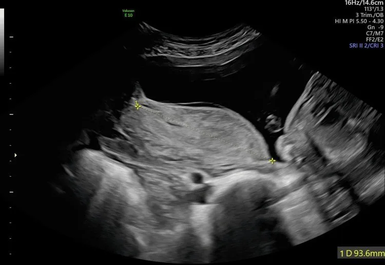 Placental abruption – Ultrasound: Placental abruption: a marginal retroplacental haematoma on ultrasound (Photo: Lakhno I, Tkachov A, Korovai S. (Cureus, 2025), open access, CC BY 4.0)