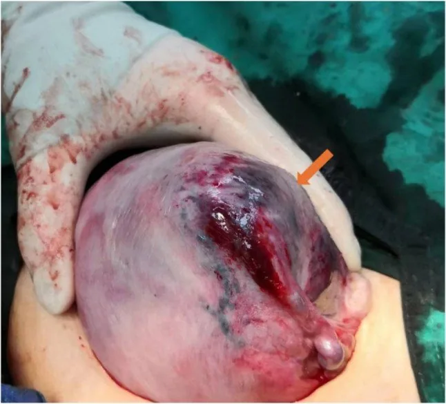 Placental abruption – Clinical: Couvelaire uterus after severe placental abruption (Photo: Nie Q, Xu Y, Wan Z, Hong F, Wang CC, Wang Z. (BMC pregnancy and childbirth 2026), open access, CC BY 4.0)