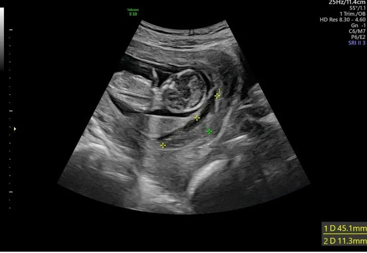 Placental abruption – Ultrasound: Retroplacental haematoma