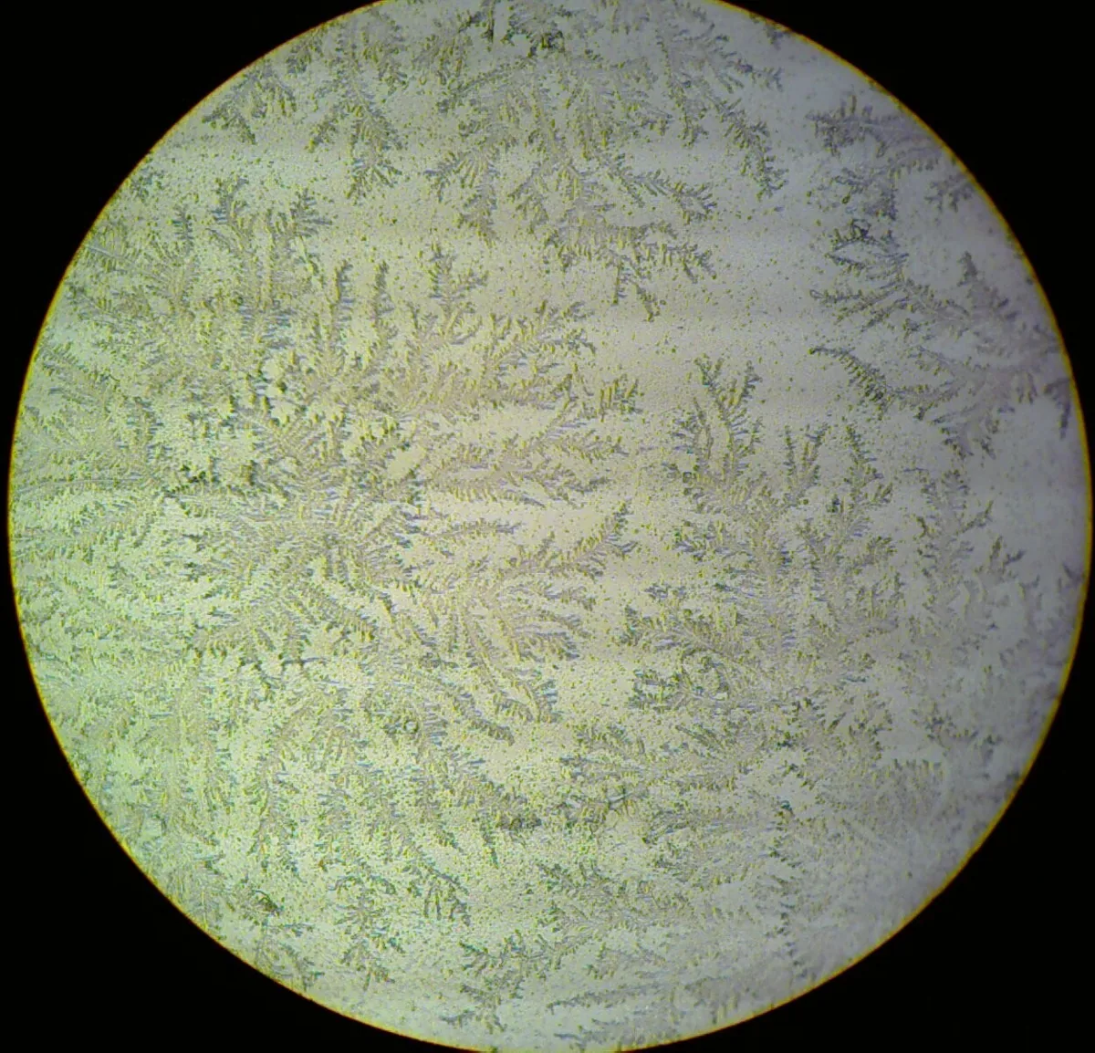 Preterm prelabour rupture of membranes (PPROM) – Histology & cytology: Positive fern test: amniotic fluid crystallises in a fern-like pattern on the slide (microscopy)