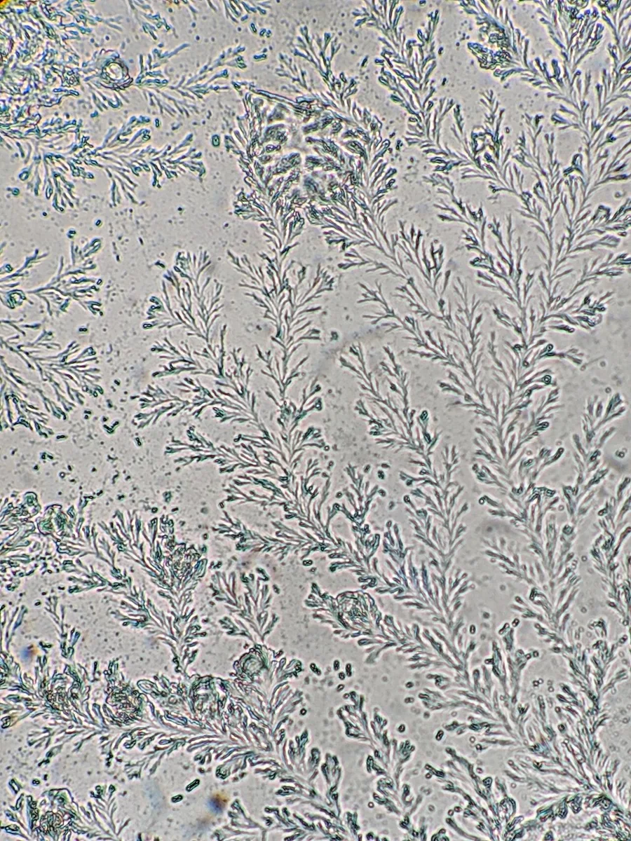 Preterm prelabour rupture of membranes (PPROM) – Histology & cytology: Ferning after rupture of membranes: dried amniotic fluid under the microscope