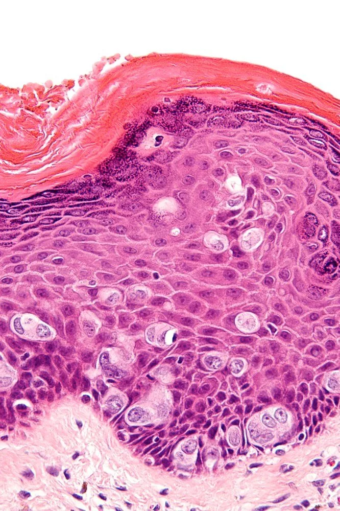 Vulväres Melanom – Histologie & Zytologie: Histologie (HE): große, hell vakuolisierte Paget-Zellen einzeln und in Nestern in der Epidermis — Morbus Paget der Vulva