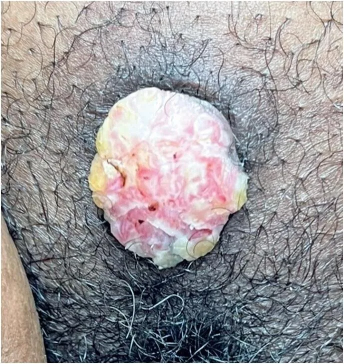 Vulvakarzinom – Klinik: Vulvakarzinom: HPV-unabhängiges Plattenepithelkarzinom auf Lichen-sclerosus-Boden