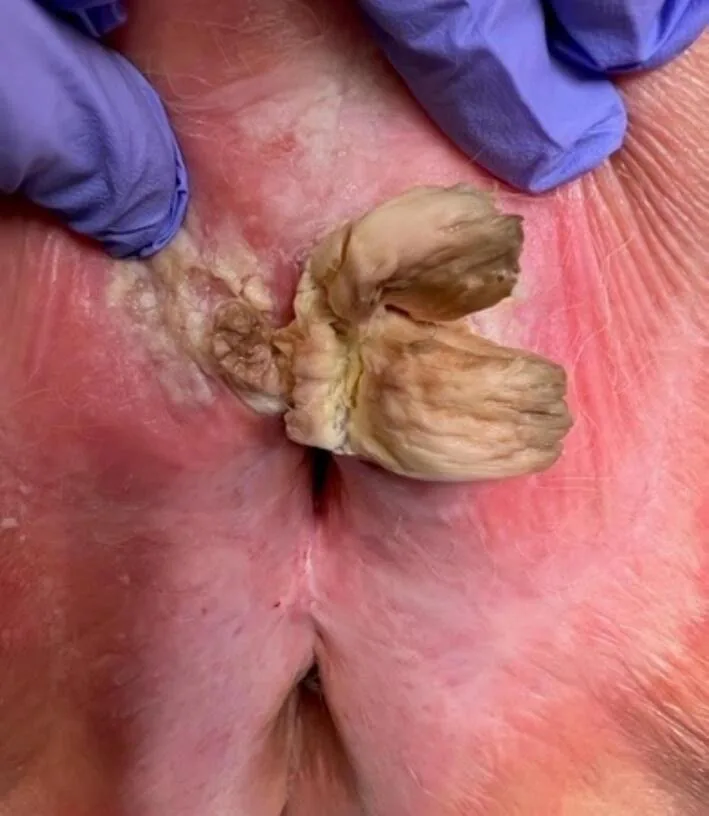 Vulvakarzinom – Klinik: Plattenepithelkarzinom der Vulva in einem Cornu cutaneum der Klitorisregion