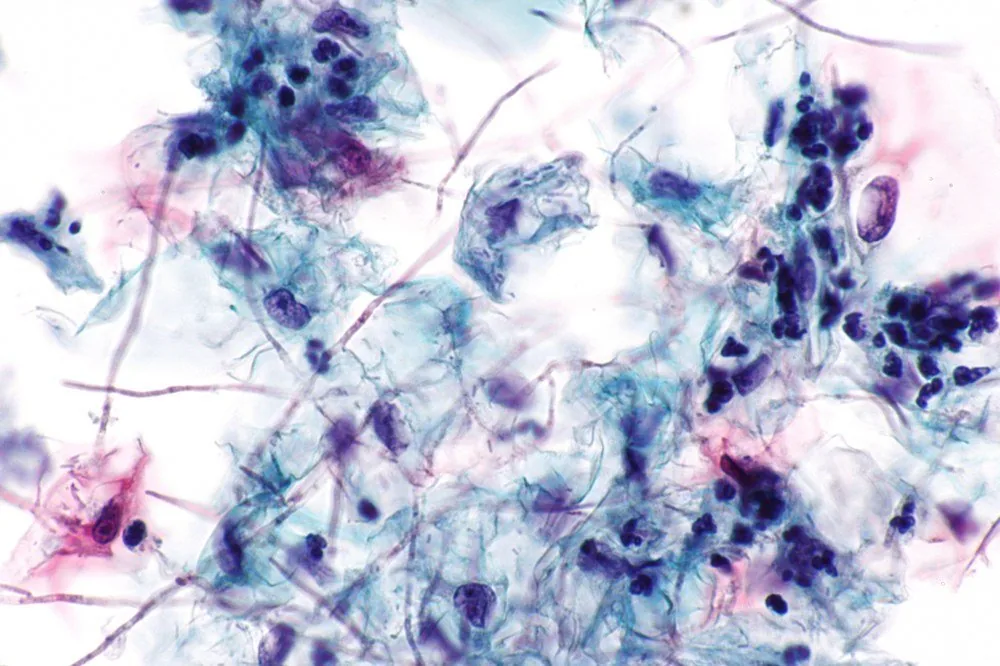 Vulvovaginalkandidose – Histologie & Zytologie: Papanicolaou-Färbung: kräftig gefärbte Pseudohyphen zwischen Plattenepithelien, dazu dichte Leukozyteninfiltration