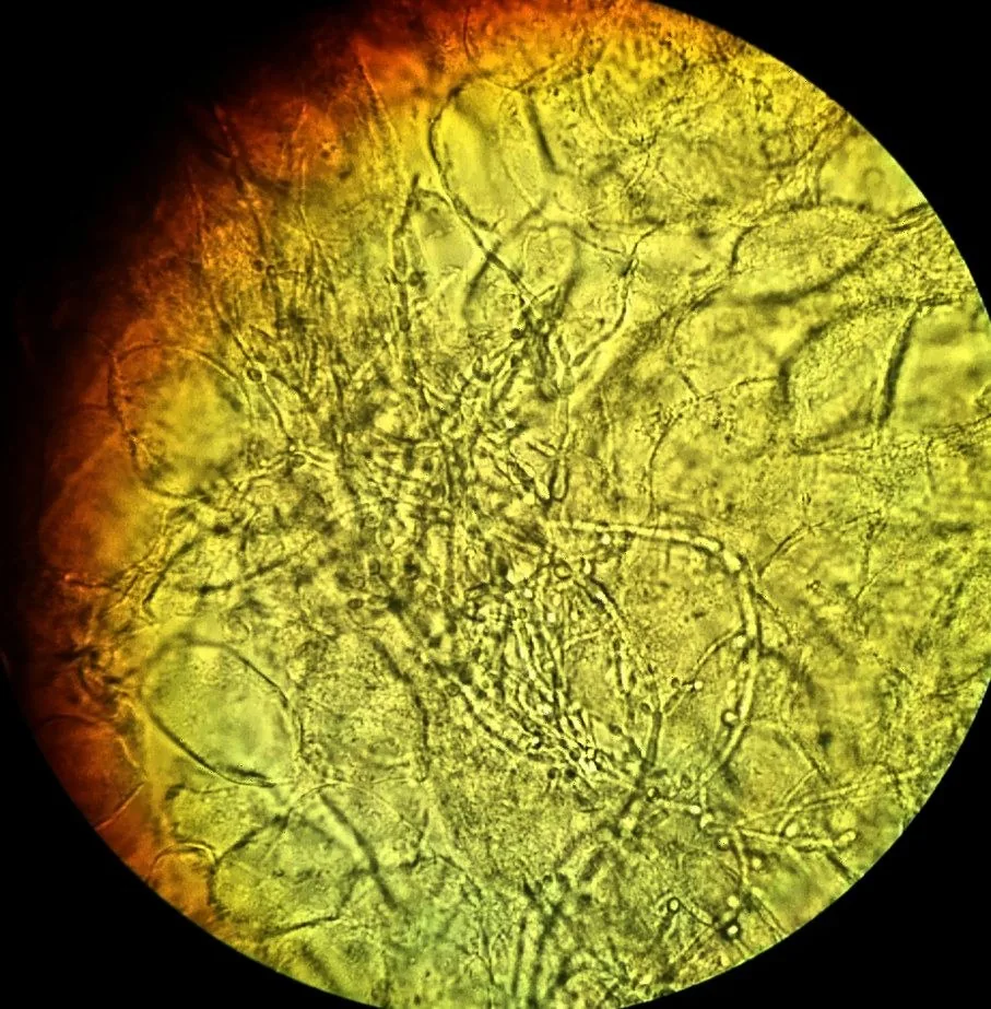 Vulvovaginalkandidose – Endoskopie & Makro: Candida im KOH-Nativpräparat