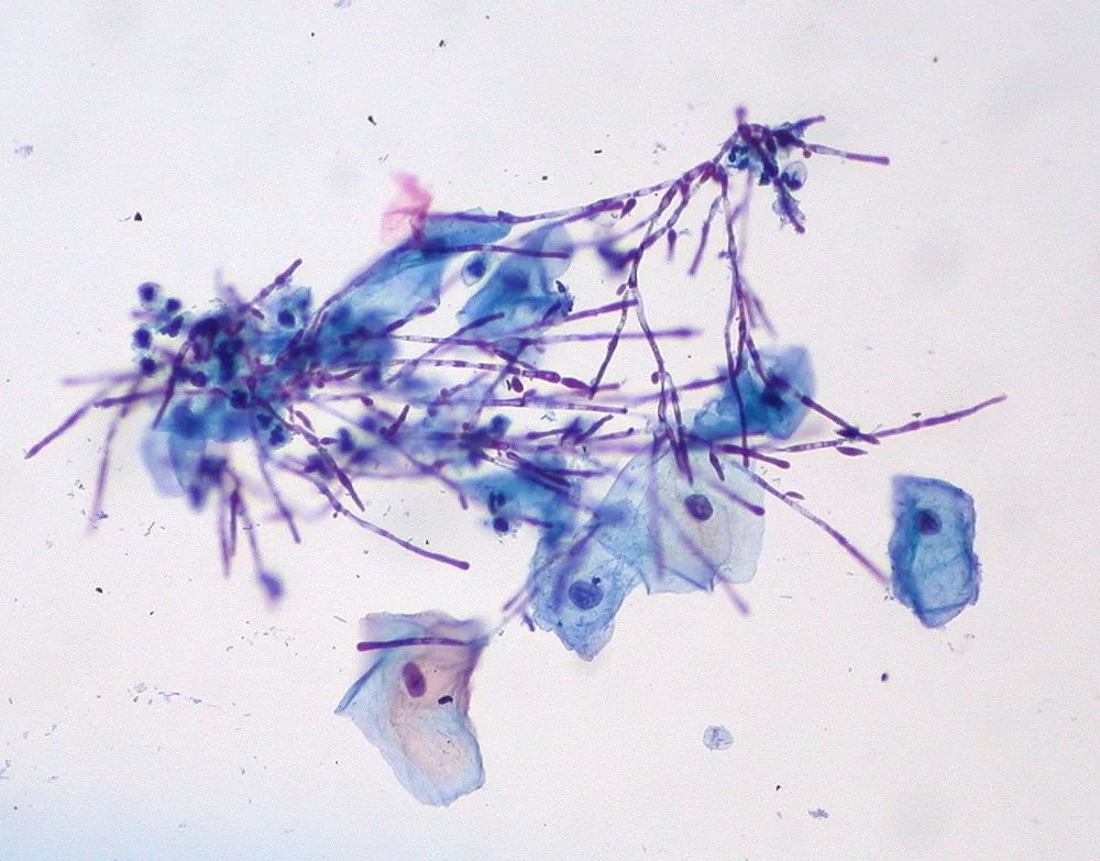 Vulvovaginalkandidose – Histologie & Zytologie: Candida-Pseudomyzelien (Dünnschichtzytologie)