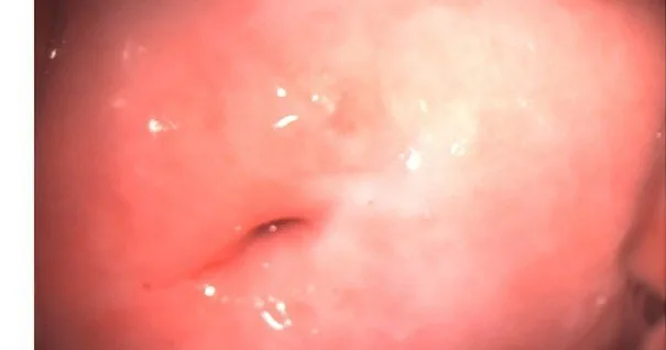 Cervical dysplasia (CIN) – Colposcopy: Type 3 transformation zone — the squamocolumnar junction is not visible