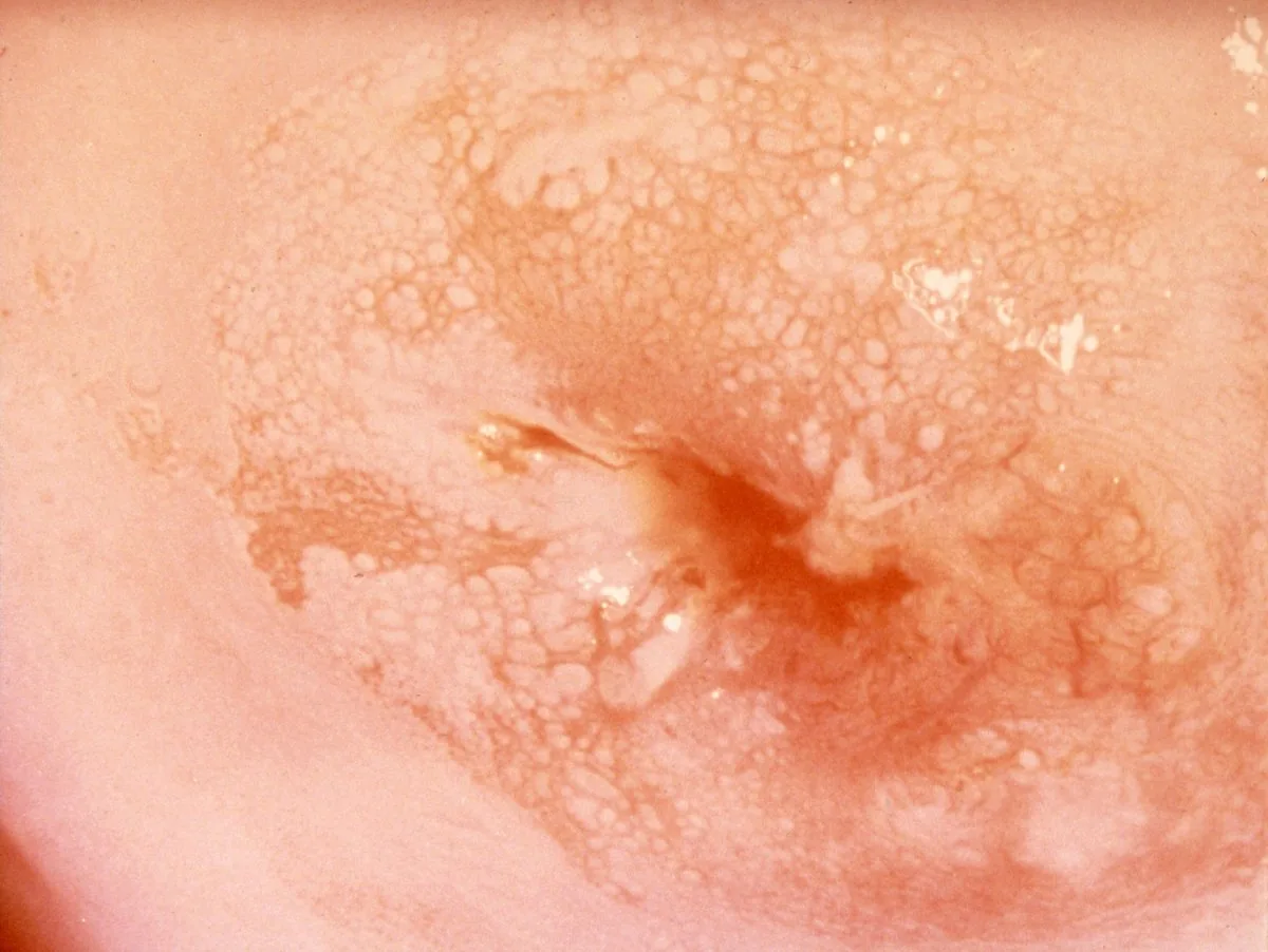Cervical dysplasia (CIN) – Colposcopy: Dense, sharply demarcated acetowhite epithelium — a grade 2 major change