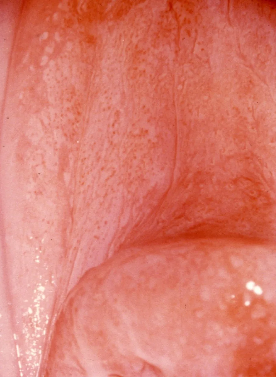 Cervical dysplasia (CIN) – Colposcopy: Coarse mosaic on the cervix — a major colposcopic change (Photo: NCI, 'An Atlas of Findings of Human Females After Intrauterine Exposure to DES' (US-Bundesbehörde, PD), Wikimedia …