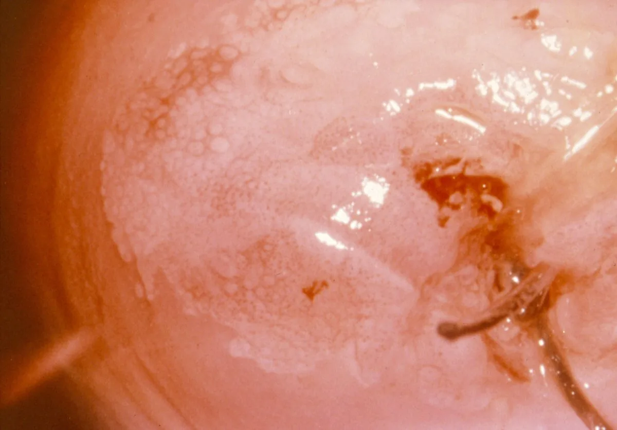 Cervical dysplasia (CIN) – Colposcopy: Fine, regular punctation — a minor change (Photo: NCI DES-Atlas (US-Bundesbehörde, PD), Wikimedia Commons, Public domain)