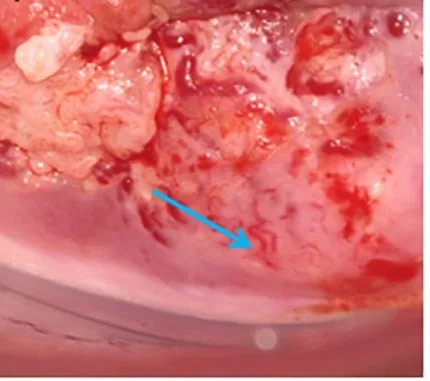 Cervical dysplasia (CIN) – Clinical: Atypical, bizarre vessels over an exophytic, necrotic cervical lesion
