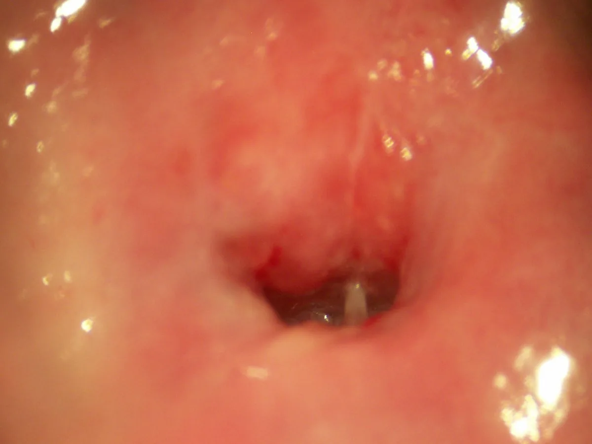 Cervical dysplasia (CIN) – Colposcopy: Ectopy/ectropion in a nullipara — red columnar epithelium around the os with a sharp squamous border