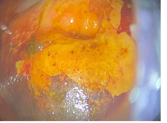 Cervical dysplasia (CIN) – Clinical
