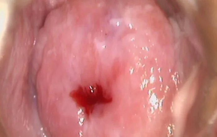 Cervical dysplasia (CIN) – Colposcopy: Close-up of the external cervical os with cervical mucus