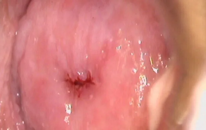 Cervical dysplasia (CIN) – Colposcopy: Cervix before acetic acid — the baseline colposcopic view (Photo: Milic N, Varnicic Lojanica M, Ivanovic S et al., Diagnostics (Basel) 2026, open access, CC BY 4.0)