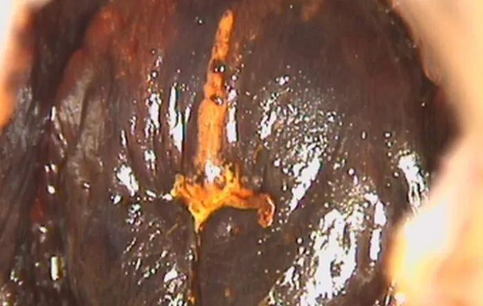 Cervical dysplasia (CIN) – Colposcopy: The same cervix one minute after 3% acetic acid — only faint acetowhitening around the os (Photo: Milic N, Varnicic Lojanica M, Ivanovic S et al., Diagnostics (Basel) 2026, open access, …