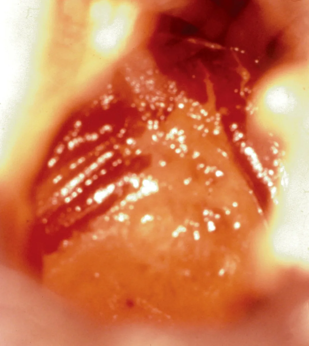 Cervical dysplasia (CIN) – Colposcopy: Lugol test: a mahogany-brown iodine-positive cervix with a clearly yellow iodine-negative area at the os (Photo: Milic N, Varnicic Lojanica M, Ivanovic S et al., Diagnostics (Basel) …
