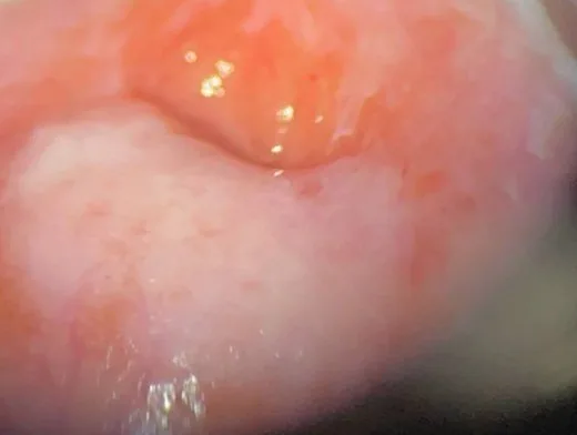 Cervical dysplasia (CIN) – Colposcopy: Iodine-negative (yellow) cervix after Lugol solution — a Schiller-positive finding (Photo: NCI DES-Atlas (US-Bundesbehörde, PD), Wikimedia Commons, Public domain)
