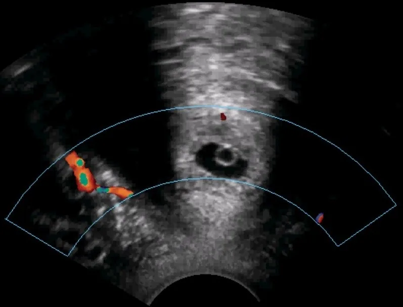 Zervixgravidität – Sonographie: Zervixgravidität im Querschnitt mit Farbdoppler (peritrophoblastäre Perfusion)