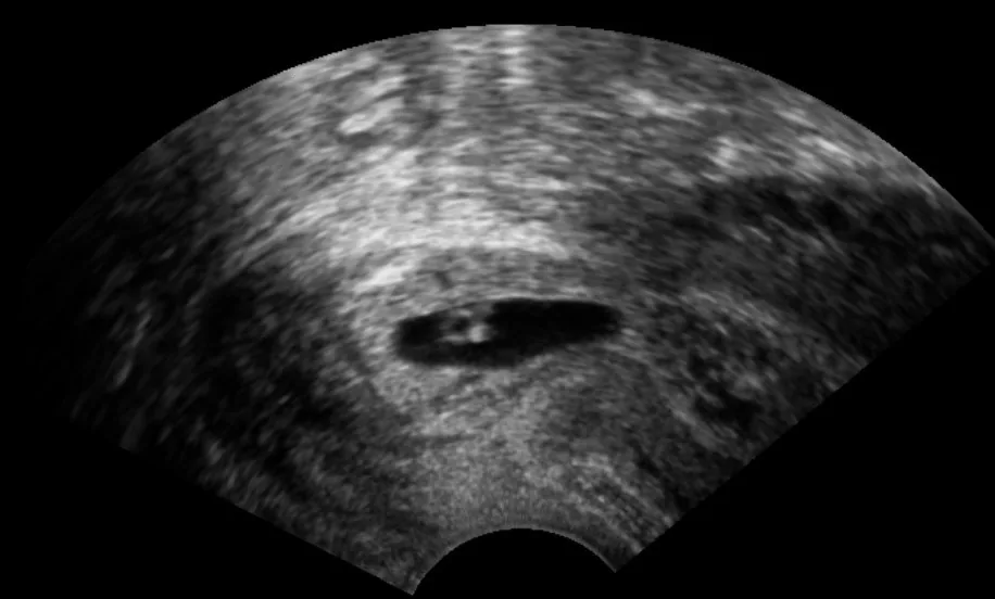 Zervixgravidität – Sonographie: Zervixgravidität: Fruchtsack im Zervikalkanal