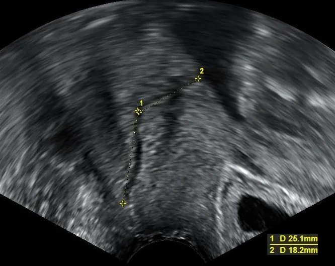Cervical insufficiency – Ultrasound: Transvaginal cervical length measurement at 22 weeks