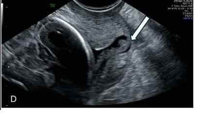 Cervical insufficiency – Ultrasound