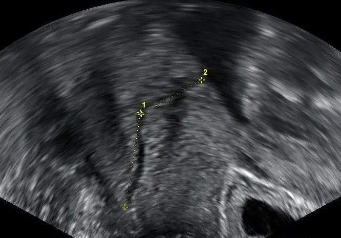 Cervical insufficiency – Ultrasound