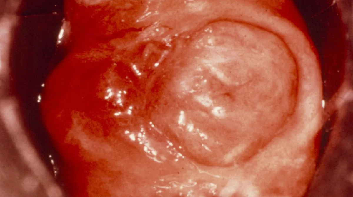 Zervixkarzinom – Kolposkopie: Hahnenkamm/Zervixkragen nach intrauteriner DES-Exposition (Foto: NCI DES-Atlas (US-Bundesbehörde, PD), Wikimedia Commons, Public domain)
