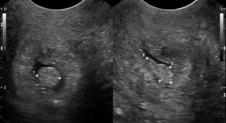 Cervical polyp and ectropion – Ultrasound: Cervical polyp on B-mode ultrasound with measurement calipers