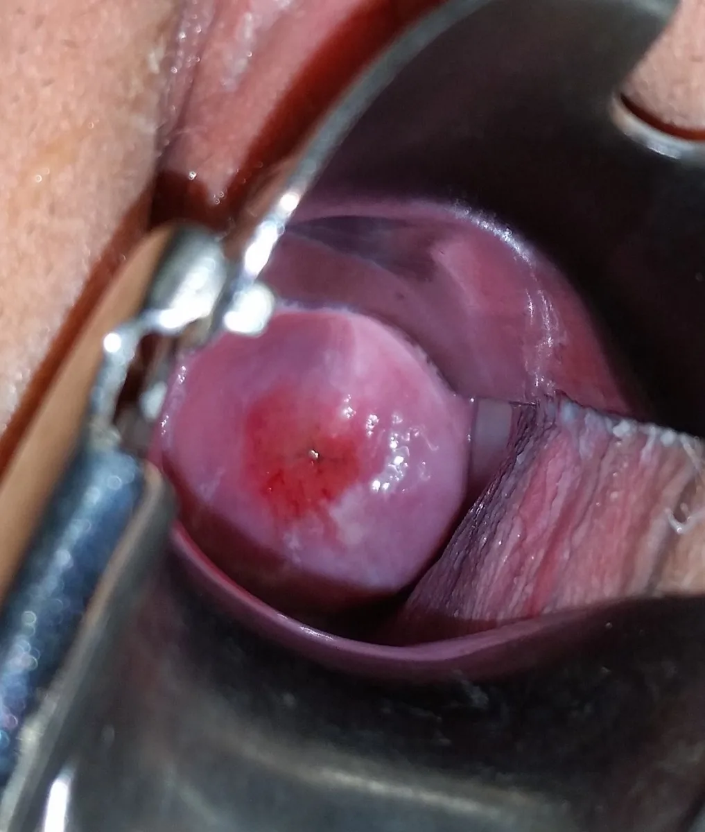 Cervical polyp and ectropion – Colposcopy: Ectopy/ectropion in a nullipara — red columnar epithelium around the os with a sharp squamous border