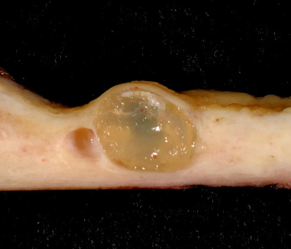 Cervical polyp and ectropion – Endoscopy & gross