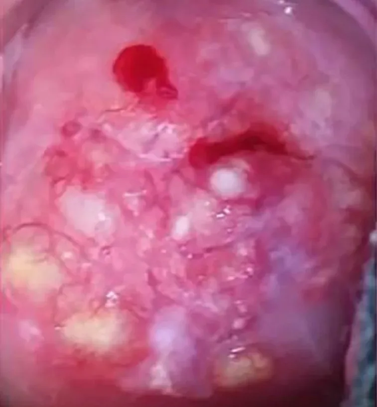 Cervical polyp and ectropion – Clinical