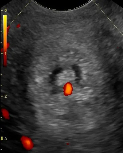 Cervical polyp and ectropion – Ultrasound: Cervical polyp on power Doppler — a single feeding vessel