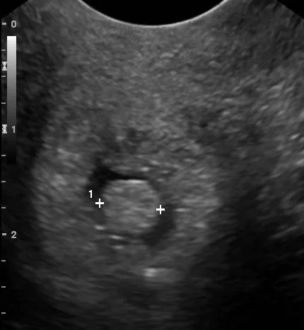 Cervical polyp and ectropion – Ultrasound